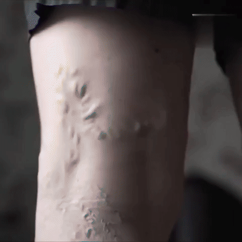 Parches para Varices - Varicose veins 12 u